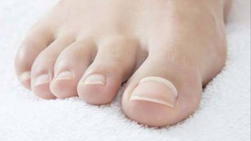 Ingrown Toenail Treatment Advanced Foot Care Nurse and