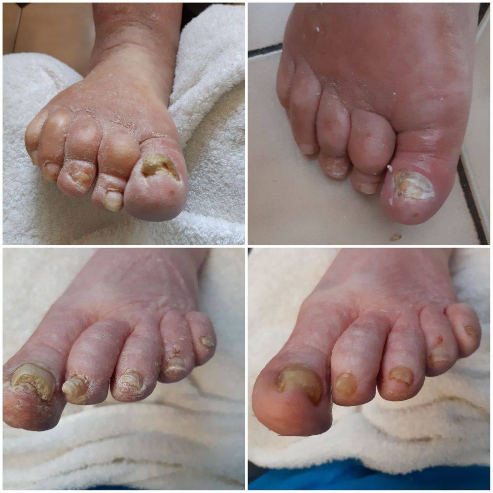 Before and After - Advanced Foot Care Nurse and Wellness | Foot Care Nurse  in Emeryville, ON
