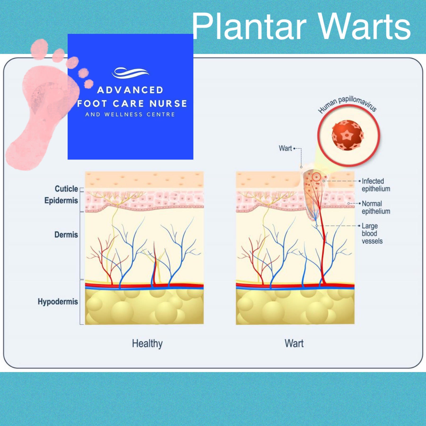 What is a Plantar Wart? - Advanced Foot Care Nurse and Wellness | Foot