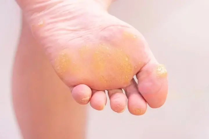 Corn Care Nurturing Feet for Optimal Health_cleanup