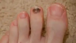 Discoloration Toenail