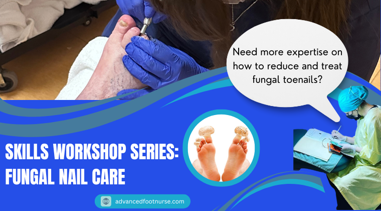 Foot Care Skills Workshop Series Fungal Nail Treatment