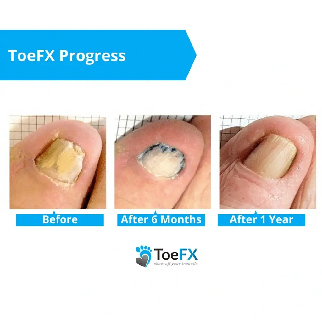 Unlocking Healthier Feet and Growing Your Practice: The Power of ToeFX Fungal Nail Therapy
